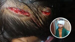 Four-year-old boy injured after stray dog attack in Deoband